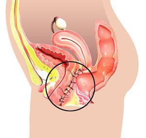 Colpocleisis