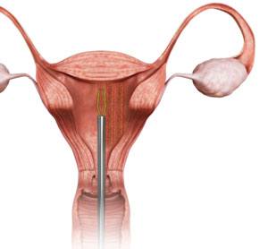 Endometrial Ablation