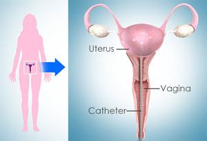 Endometrial Biopsy